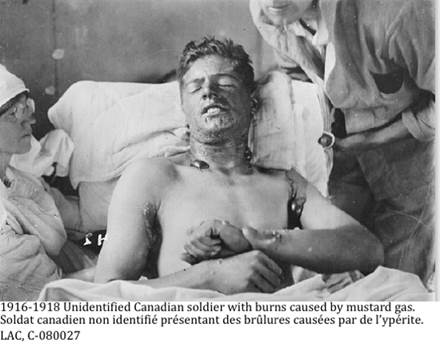 ::1916-1918 mustard gas c080027.jpg
