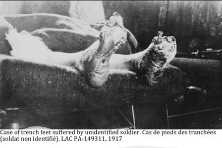 ::1917 11 00 trench foot a149311.jpg